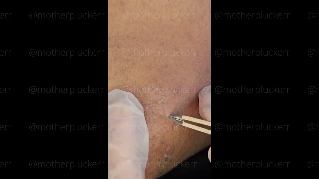 Hair Removal with Tweezers Ep. 4