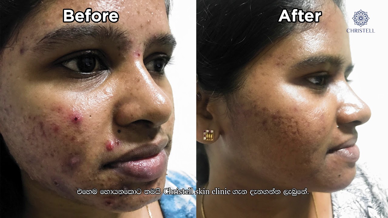 Christell Skin Clinic _Acne & Acne Scars_Testimonial