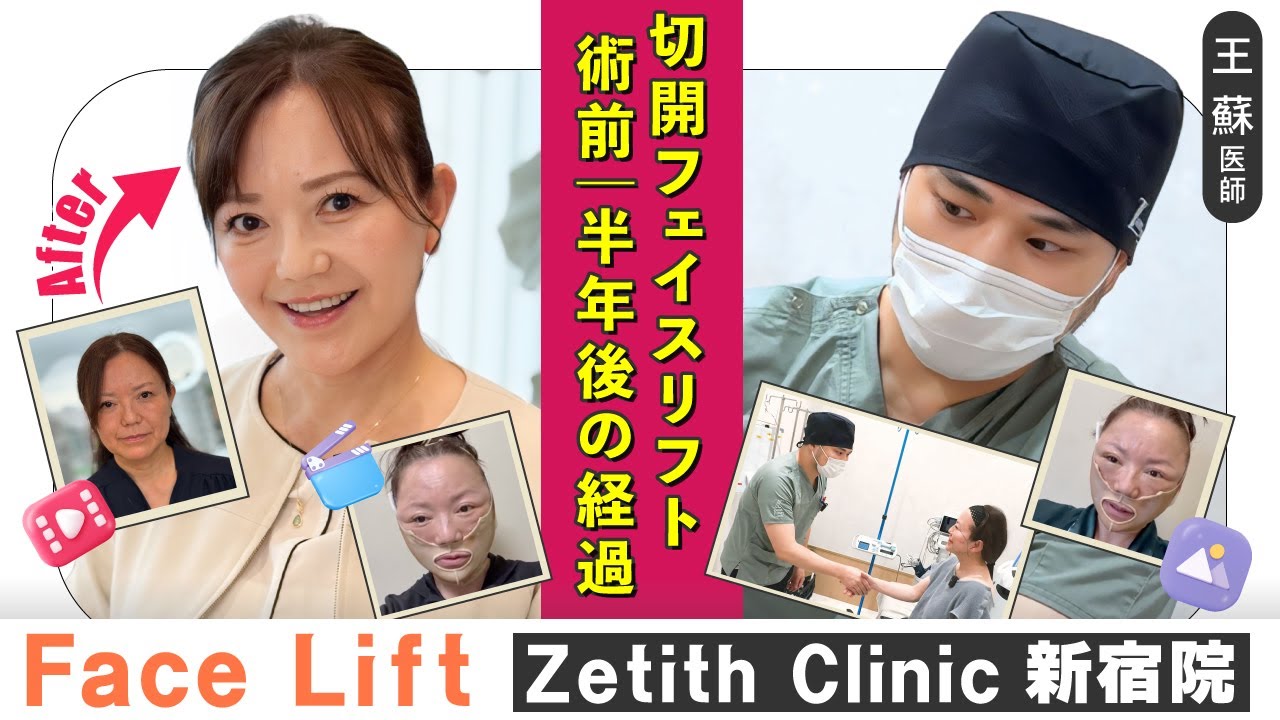 【切開フェイスリフト】フェイスリフト密着｜術前〜半年のリアル変化を完全公開！#フェイスリフト #切開フェイスリフト #切開リフト