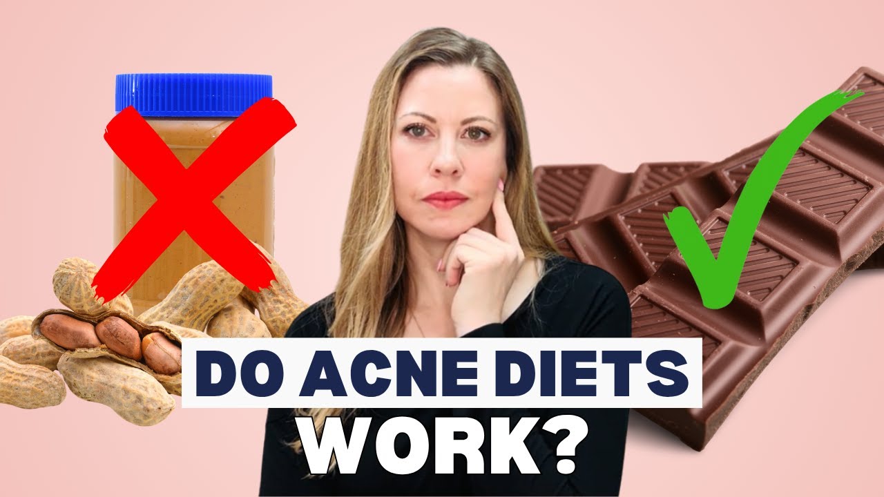STOP! Before You Try Another Acne Diet… Watch This