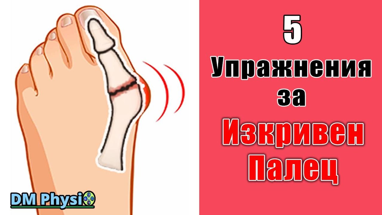 Подравняване на Палеца с Упражнения- Халукс Валгус корекция