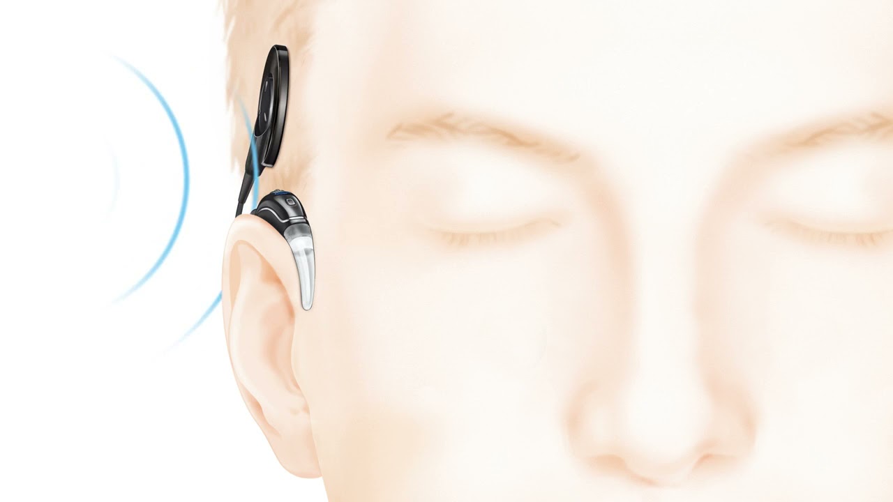 How the Cochlear&trade; Nucleus&reg; implant system works