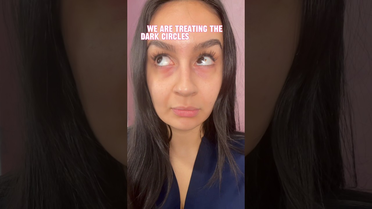 PRP For Dark Circles - Get Brighter Under Eyes