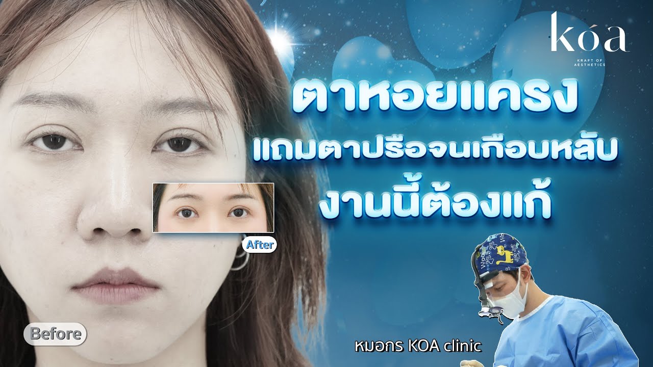 แก้ตาสองชั้นรอบ 3 ชั้นตาหนา-ตาล้า กลับมาสวยธรรมชาติ | KOA clinic
