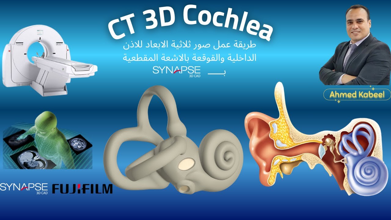 CT Petrous Bone | 3D Reconstruction of the Cochlea & Semicircular Canals (Synapse 3D  Workstation)