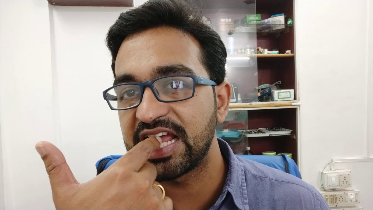 OSMF AND LEUKOPLAKIA KEY POINTS TO NOTE