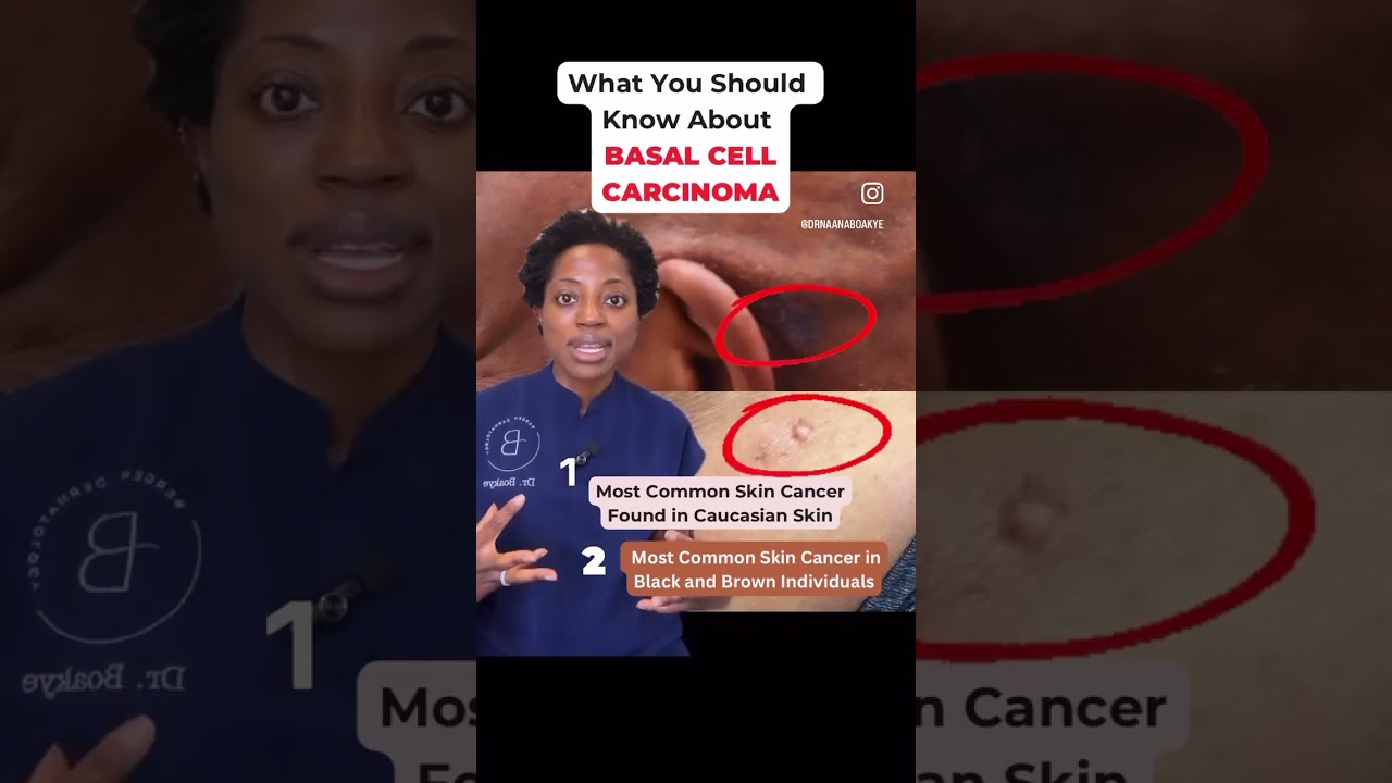 Dermatologist Explains What You Should Know About Basal Cell Carcinoma Part 1 #shorts #storytime