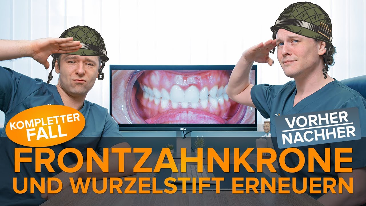 Frontzahnkronen + Wurzelstift nach ⚡ Fraktur ⚡ erneuern - Kompletter Fall inkl. vorher Nacher