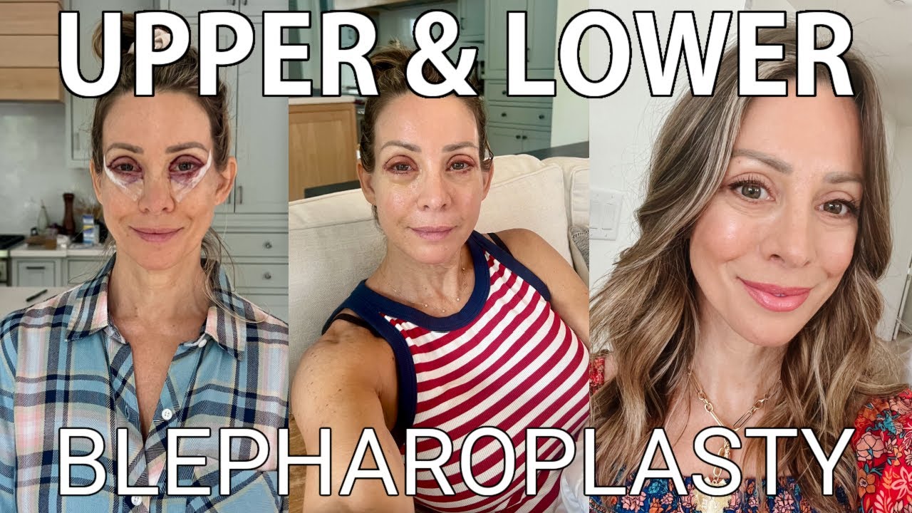 Upper & Lower Blepharoplasty Day by Day Procedure and Recovery | Honey We're Home