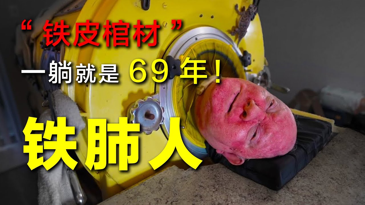 &ldquo;铁肺人&rdquo;保罗：一生无法呼吸，离开铁桶就是死，一躺就是69年！