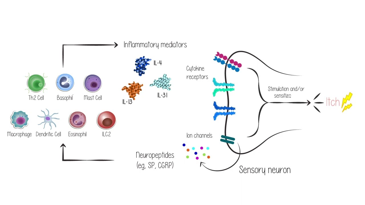 Itch & Nodule Formation in Prurigo Nodularis: Roles of Neuronal Dysregulation & Type 2 Inflammation
