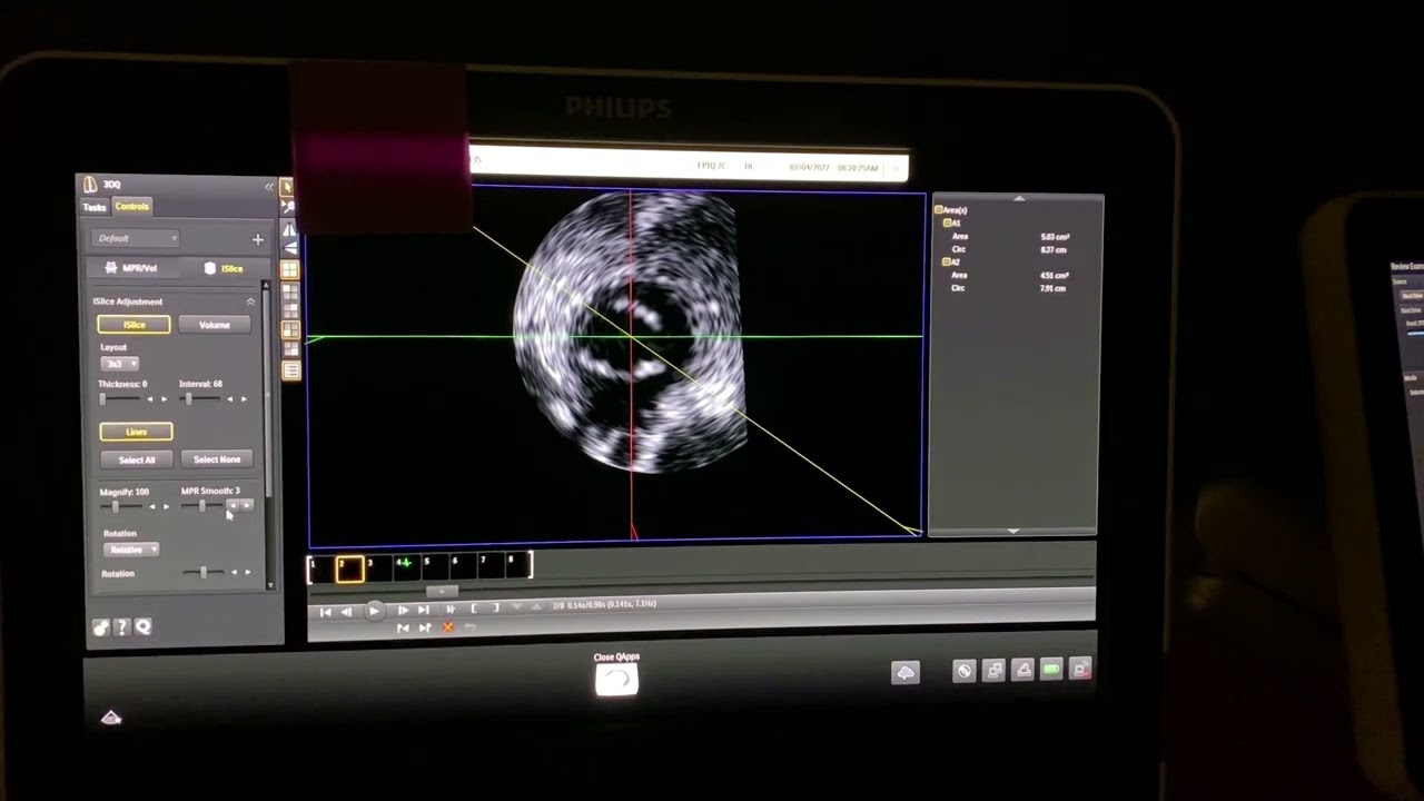 How to use Multiplanar Reconstruction (MPR) on a Phillips EPIQ echocardiogram