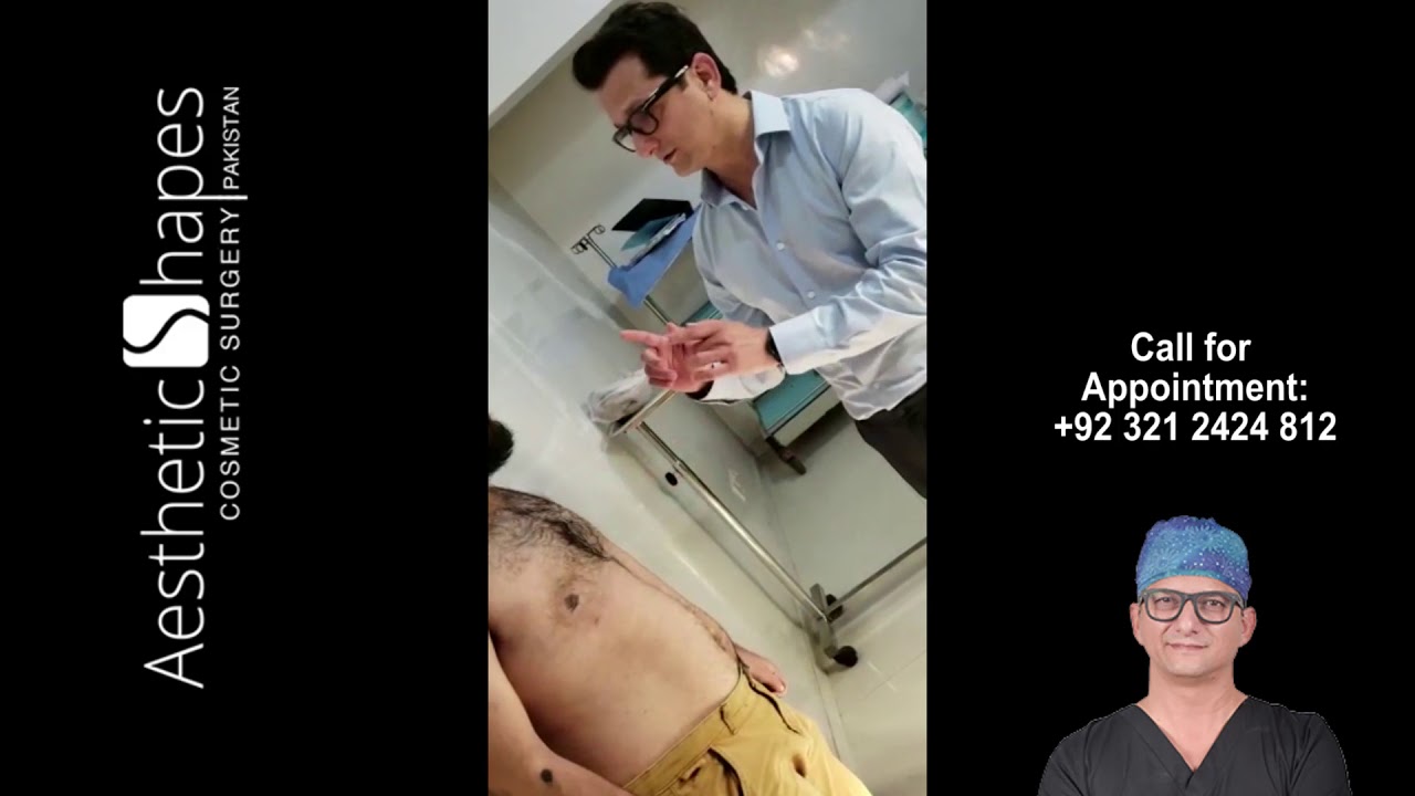 Gynecomastia Surgery Results After 3 Weeks in Pakistan by Dr Arif Hussain Plastic Surgeon