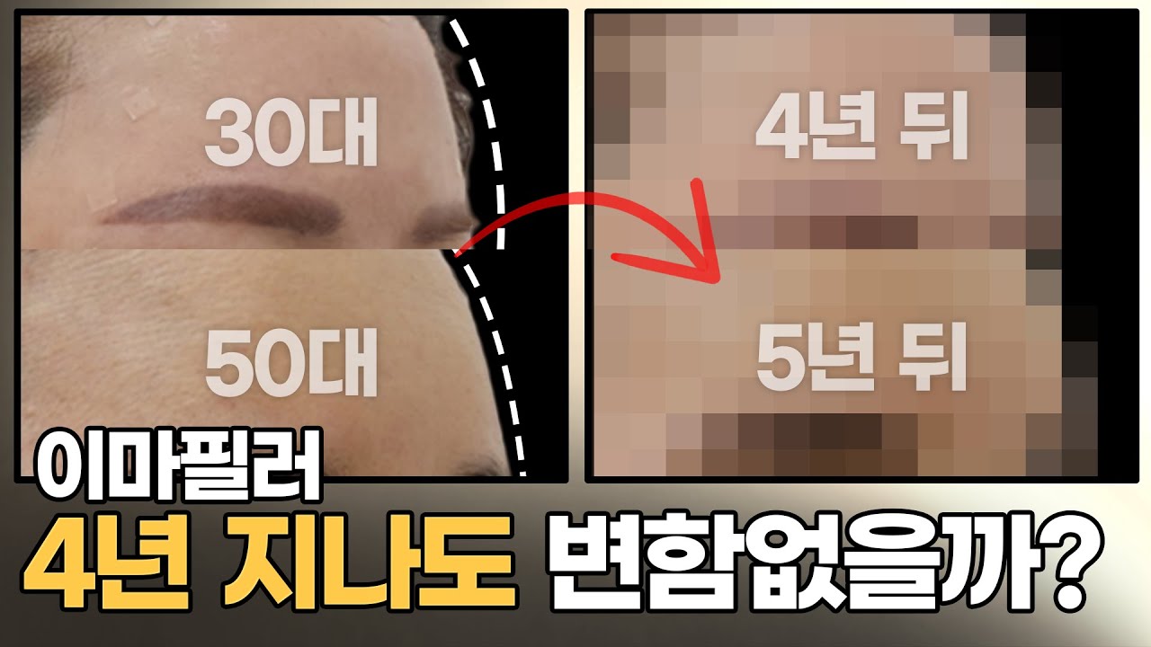 이마필러 전 필수시청‼️ 4년 동안 유지한 20대~60대 실제 후기 공개 | 이마필러 후기, 부작용, 유지기간