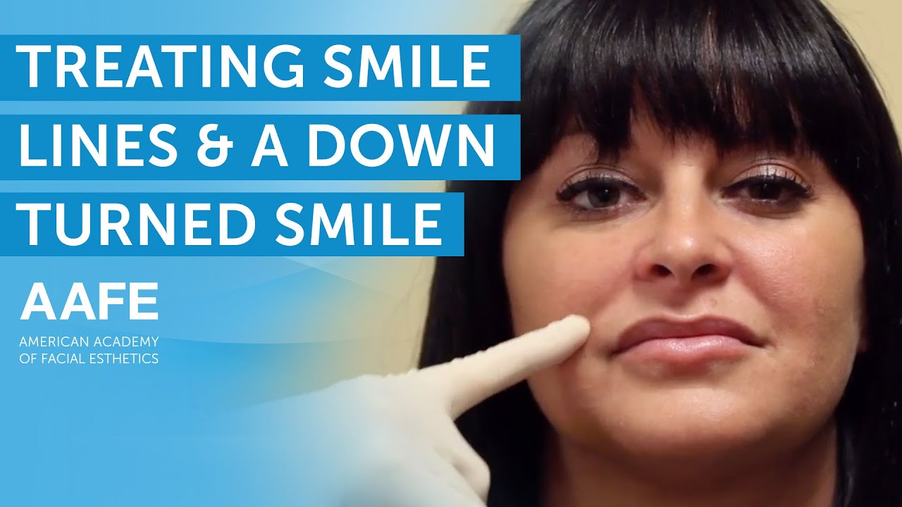 Treating Smile Lines and a Downturned Smile | AAFE