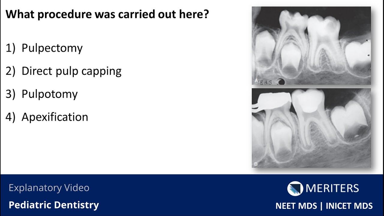 NEET MDS | INICET - Pediatric Dentistry| Explanatory Video | MERITERS