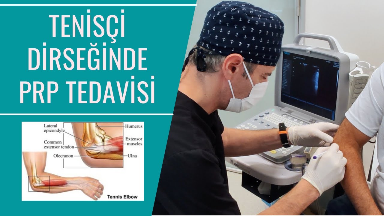 Tenisçi Dirseğinde (Lateral Epikondilit) PRP Tedavisi