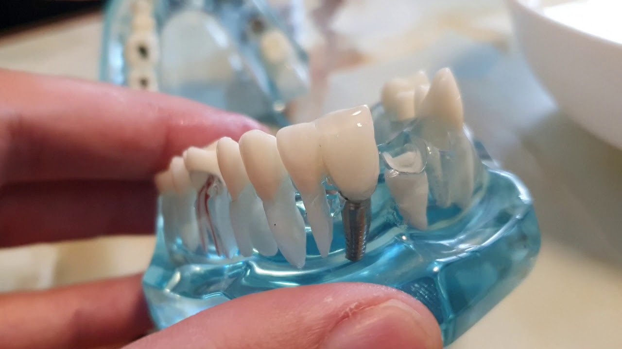 Práca s fazetami Denticor