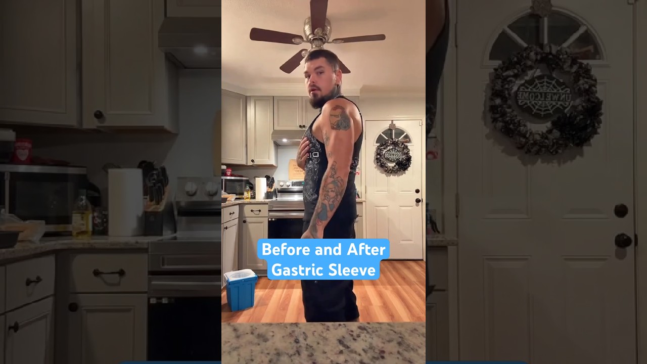 Before and After Gastric Sleeve!! 🔥