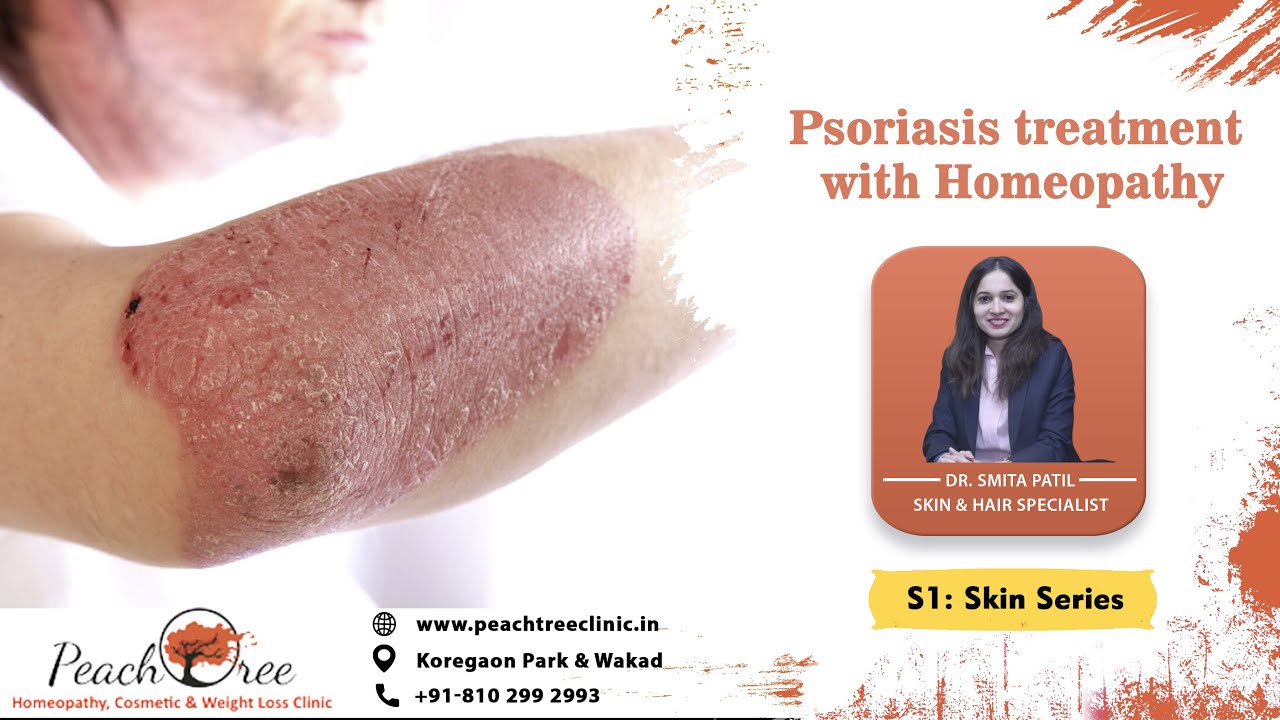 Psoriasis treatment with Homeopathy