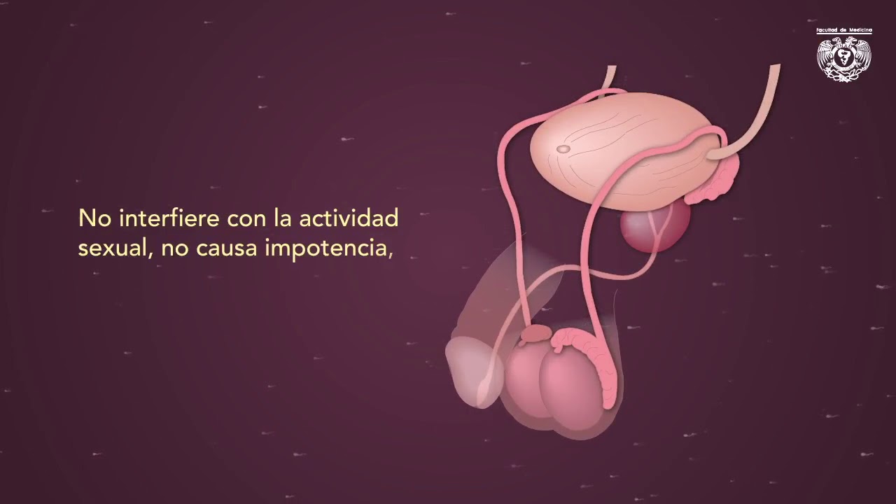 Vasectom&iacute;a