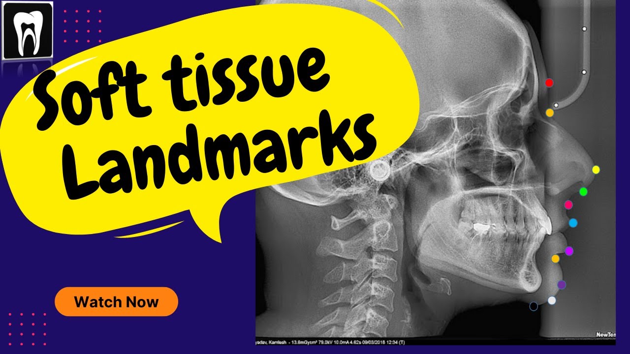Lateral cephalogram x ray | Lateral cephalogram x ray anatomy | Soft tissu landmark