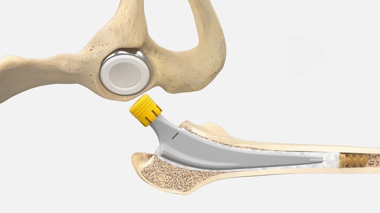 AESCULAP® Bipolar Cup & Excia® T Cemented
