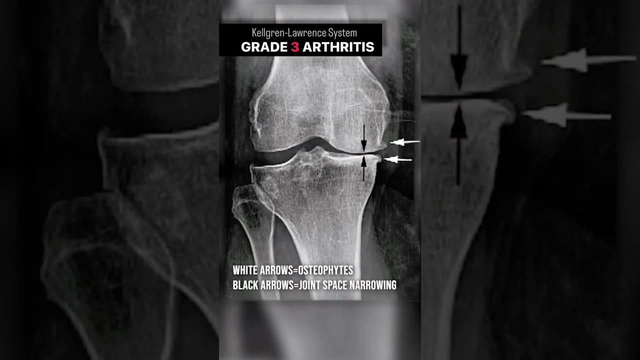 Knee Arthritis Grades 0 to 4 Explained &mdash; The Kellgren-Lawrence Scale #shorts