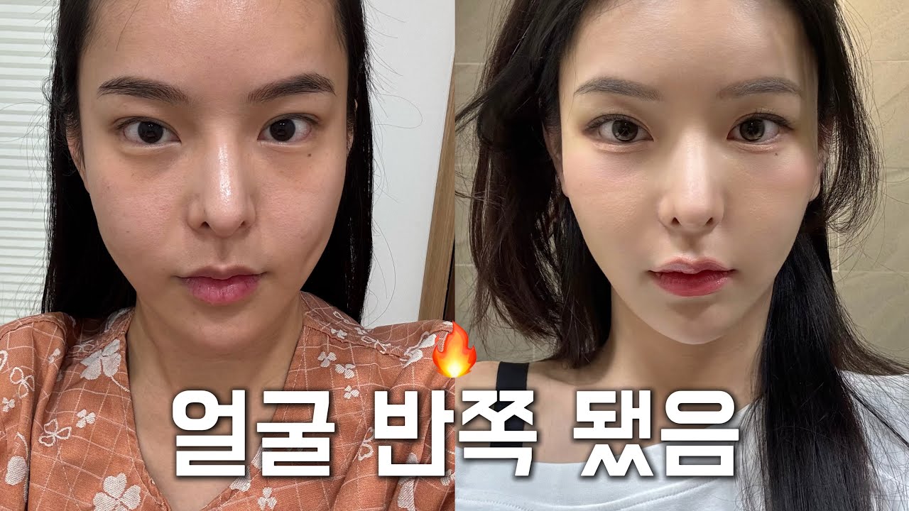 만족도 100% 얼굴 반쪽 된 울쎄라+쥬베룩 후기 (귤껍질 모공도 탈출 대성공🍊)