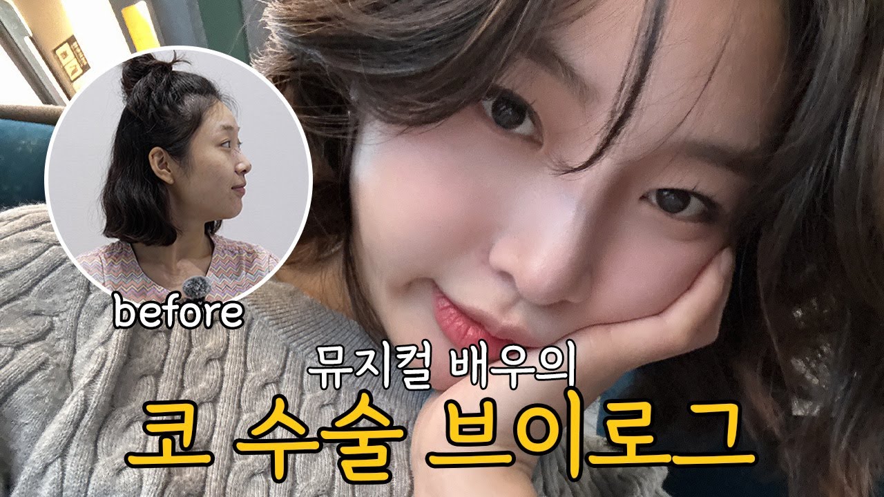 [코 수술 V-log] 카리나처럼 되고싶은 뮤직컬 배우의 코를 수술하게 된다면?!  #코수술 #코수술후기 #코수술브이로그