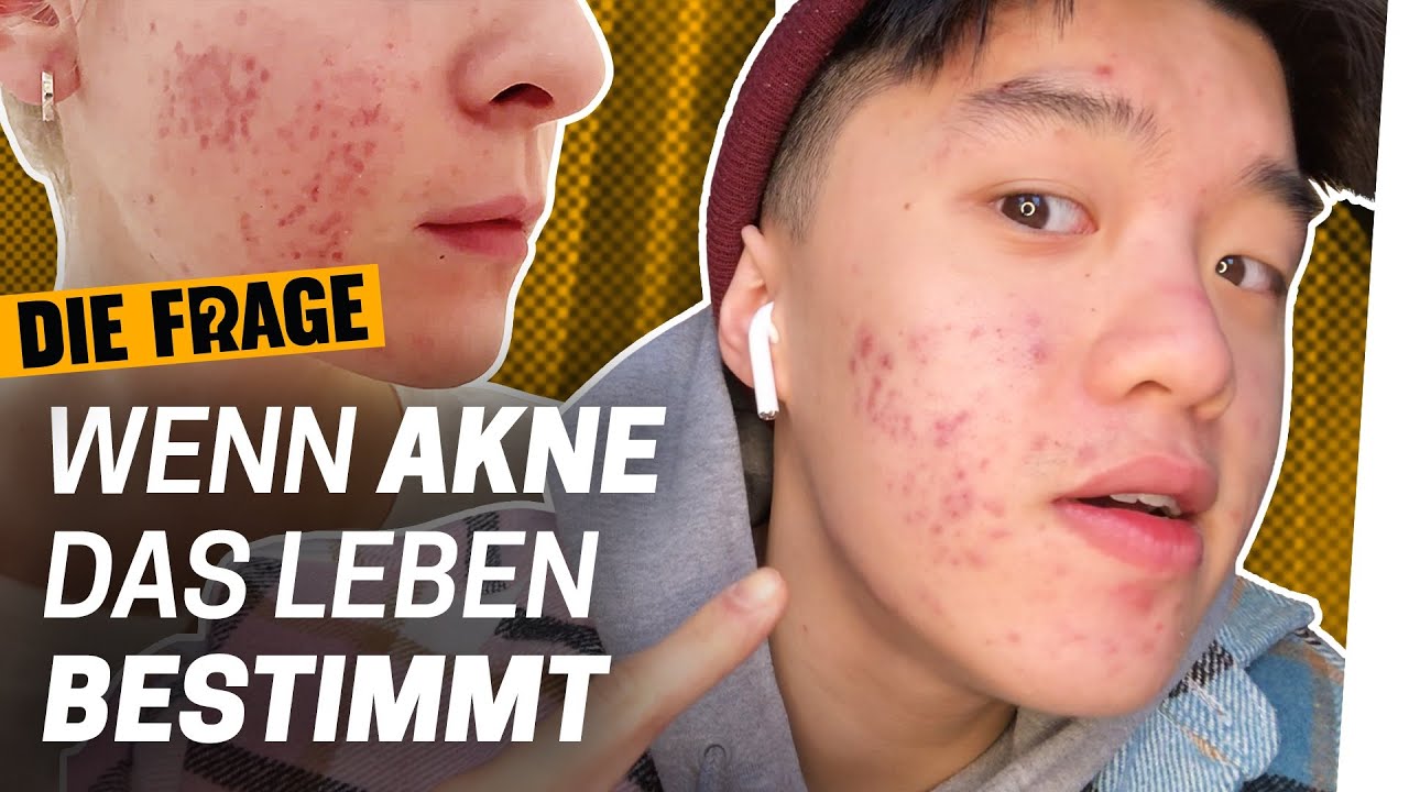 Akne: Mehr als nur Pickel | Wie komme ich mit meinem Körper klar? Folge 5