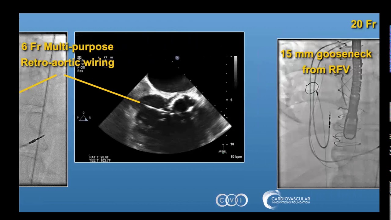 Ao to RA Fistula Case