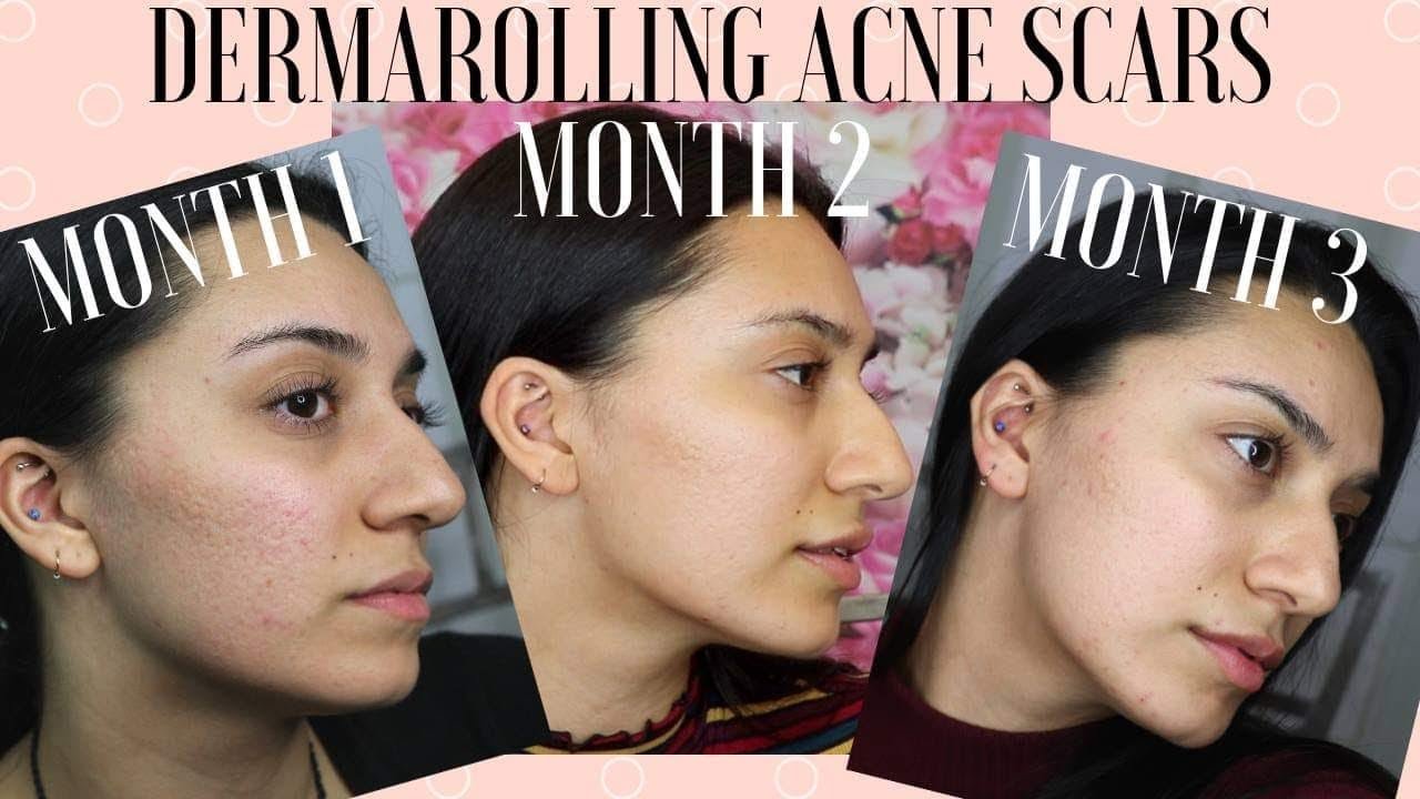 DERMAROLLING FOR 3 MONTHS!!! | Before & After