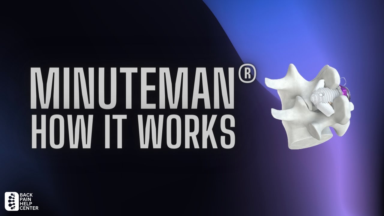 Minuteman Spine Procedure - How It Works - G5