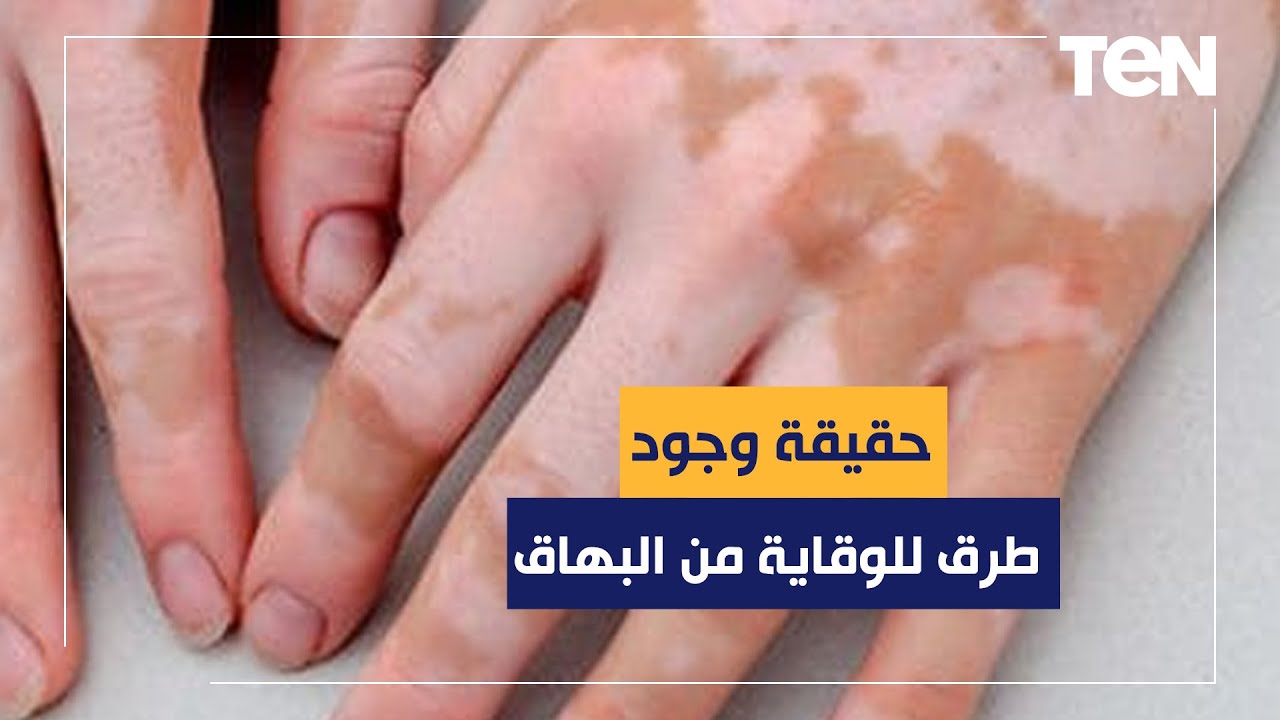 هل هناك طرق للوقاية من البهاق؟ الدكتور هاني الناظر يجيب
