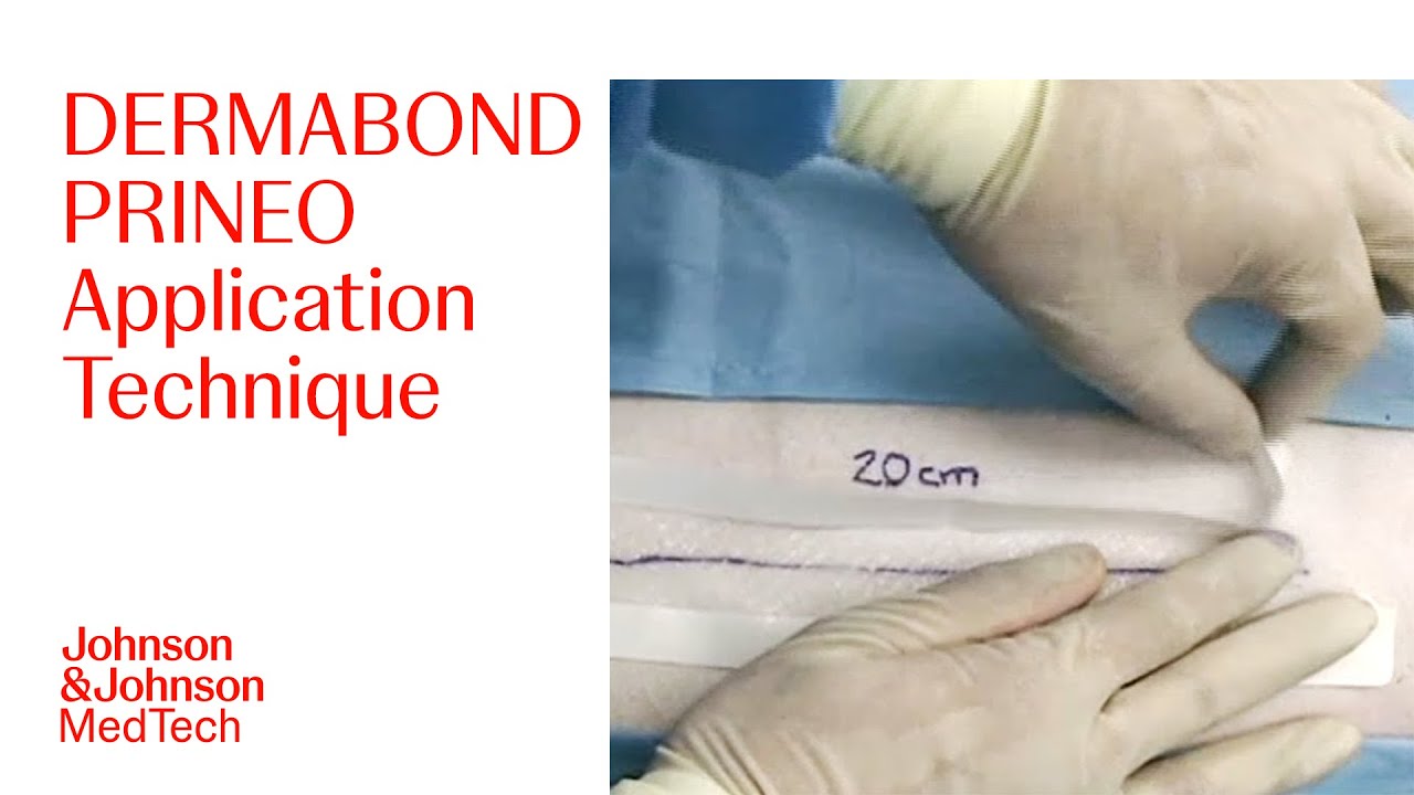 DERMABOND PRINEO Application Technique Demonstration | J&J MedTech