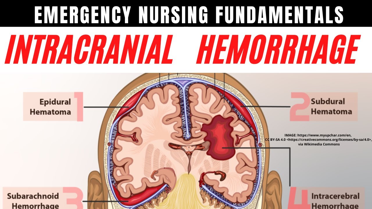 ⚡Intracranial Hemorrhage⚡ Hemorrhagic Strokes ⚡ Emergency Nurse Tips! Brain Bleeds Explained! ✅