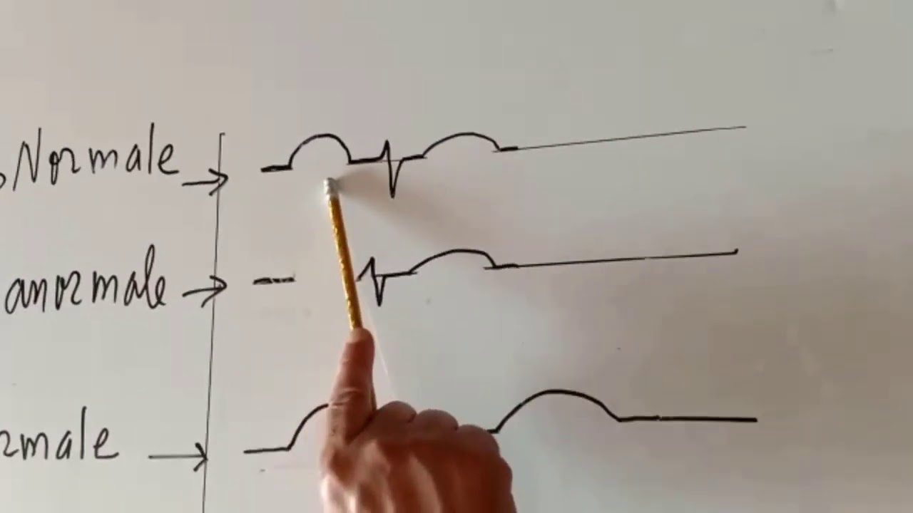 ECG Interpretation tres facile de l ECG 16eme partie HYPERTROPHIE ATRIALE GAUCHE