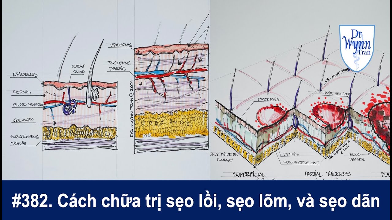 #382. Cách chữa trị hiệu quả sẹo bằng kem, laser, chích steroid, xịt lạnh, và phẫu thuật