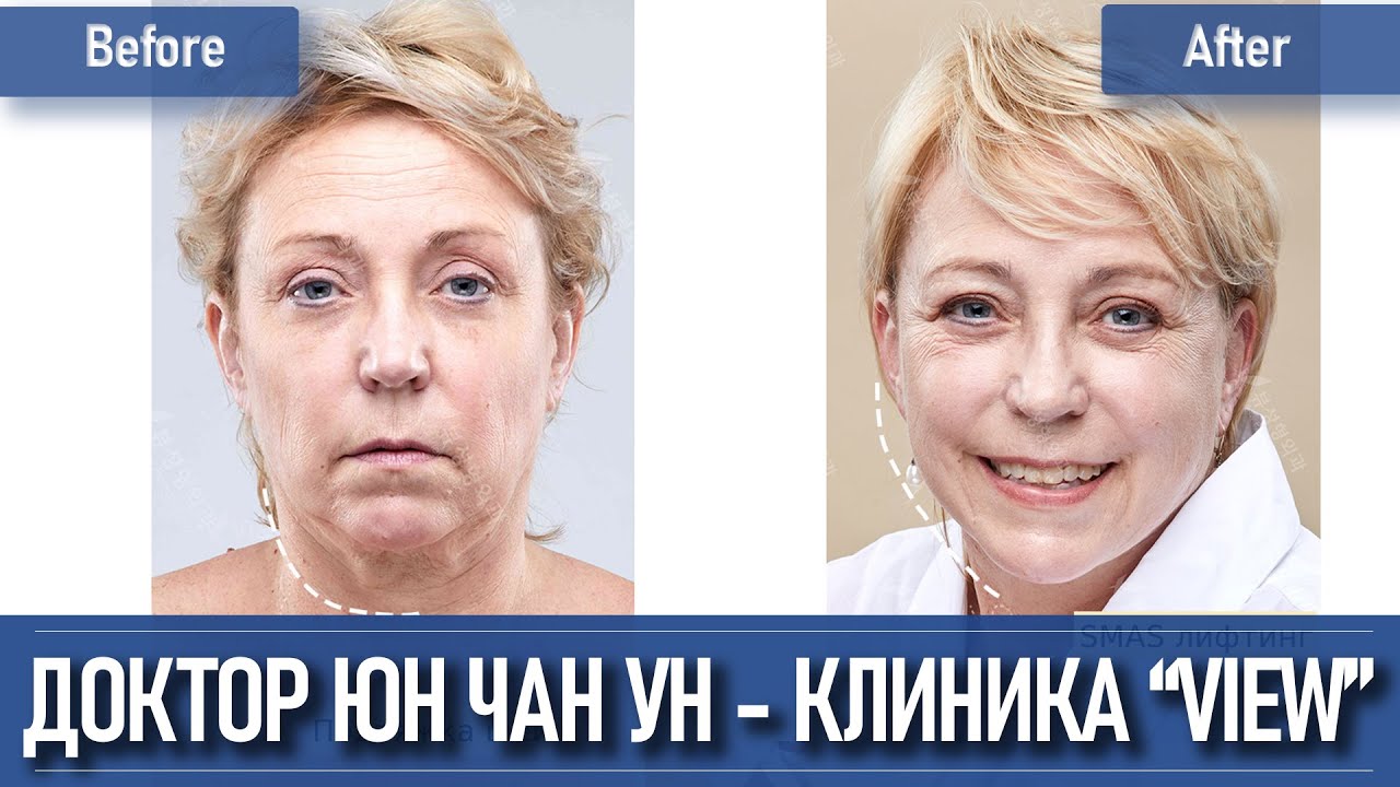 Лифтинг лица в Корее - Пластический хирург Юн Чан Ун клиника VIEW
