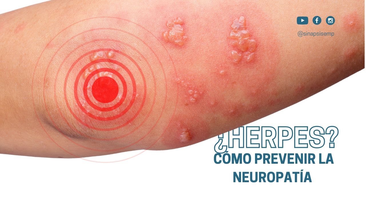 ¿Cómo prevenir la neuropatía por herpes?