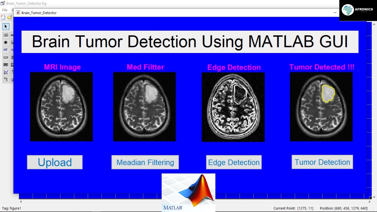 Brain Tumor Detection Using MATLAB GUI with Source Code [Image Processing 2022]