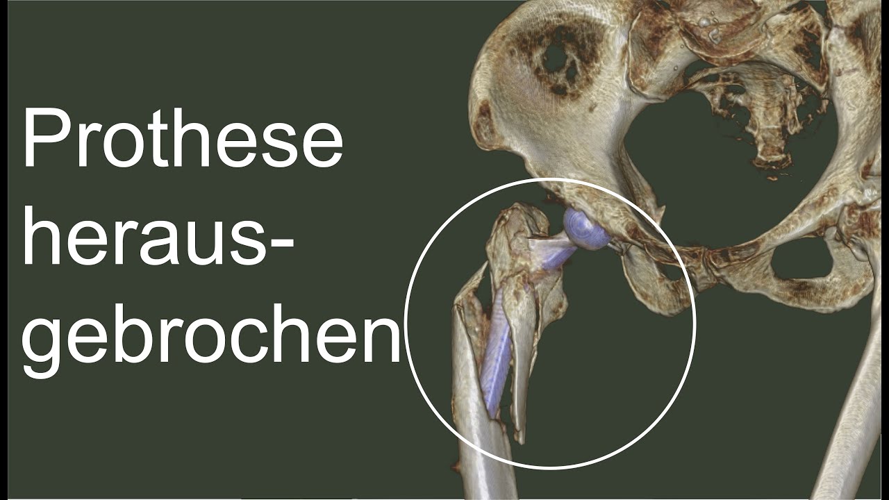 Patient stürzt mit Hüftprothese – So sieht ein herausgebrochenes Implantat aus