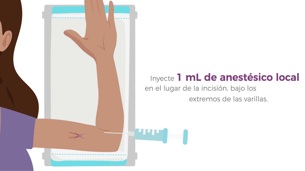 Como extraer Levoplant™
