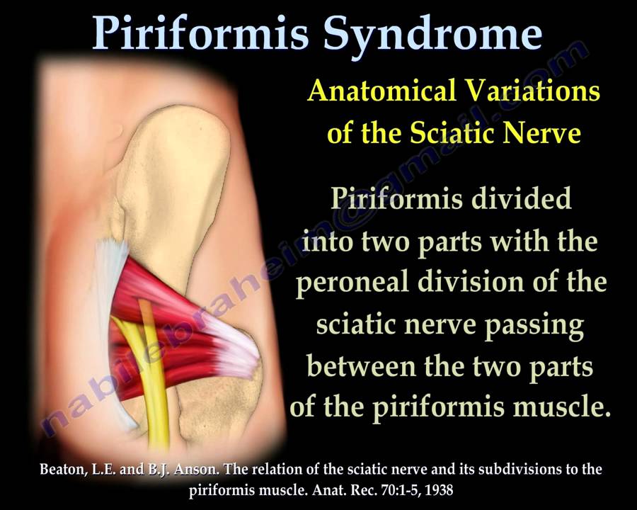 Piriformis Syndrome , sciatica  - Everything You Need To Know - Dr. Nabil Ebraheim