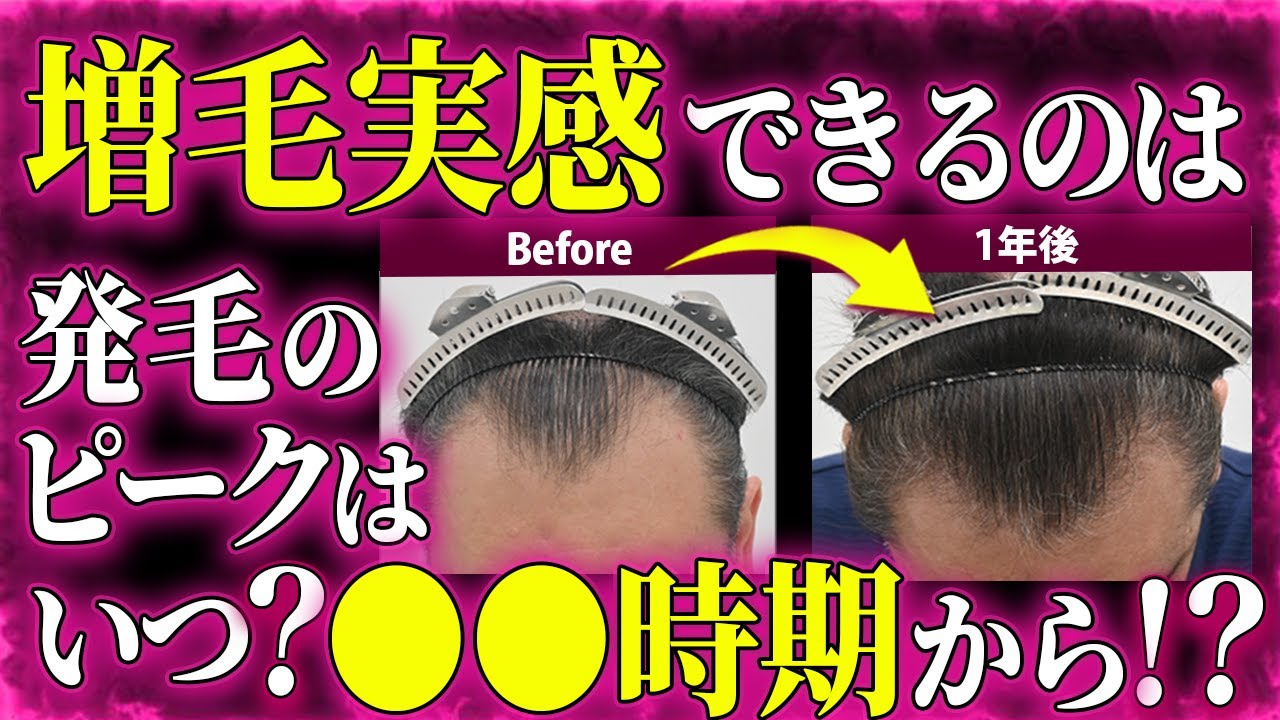 増毛を感じ始めるのはいつ⁉️薄毛治療完全ガイド