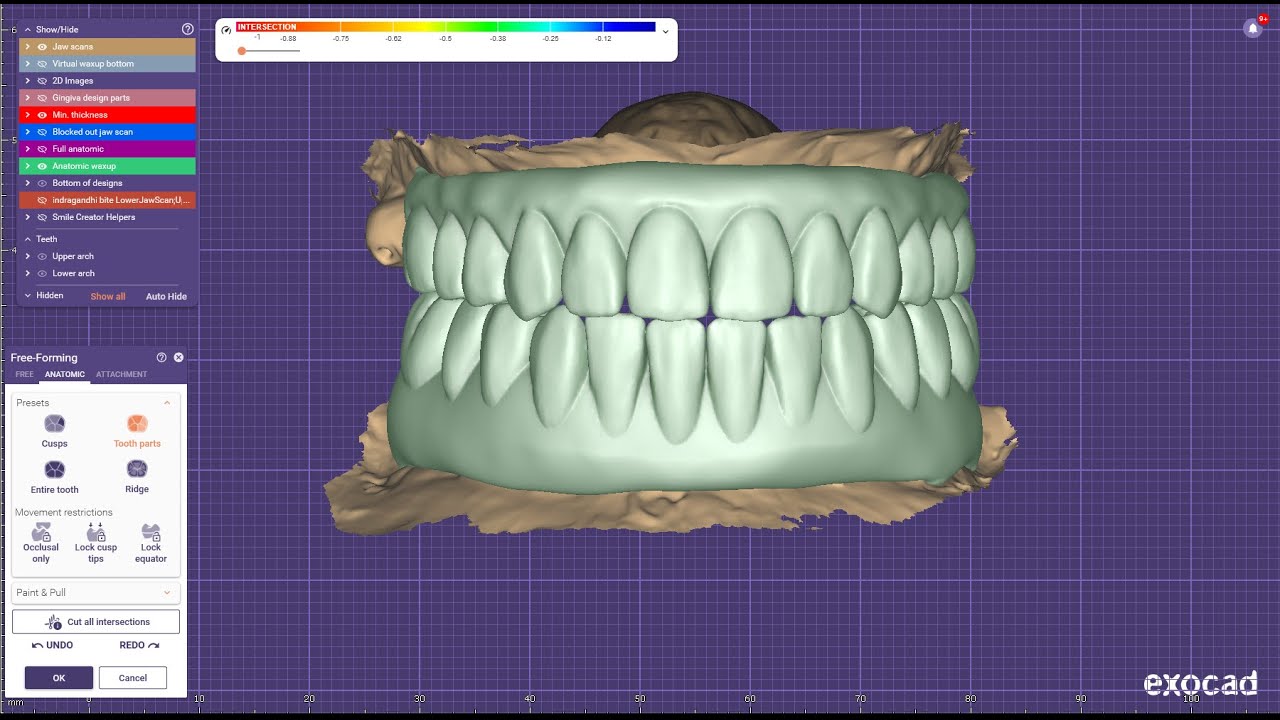 How to design - on substructure designing for full mouth rehabilitation in exocad elefsina3.2