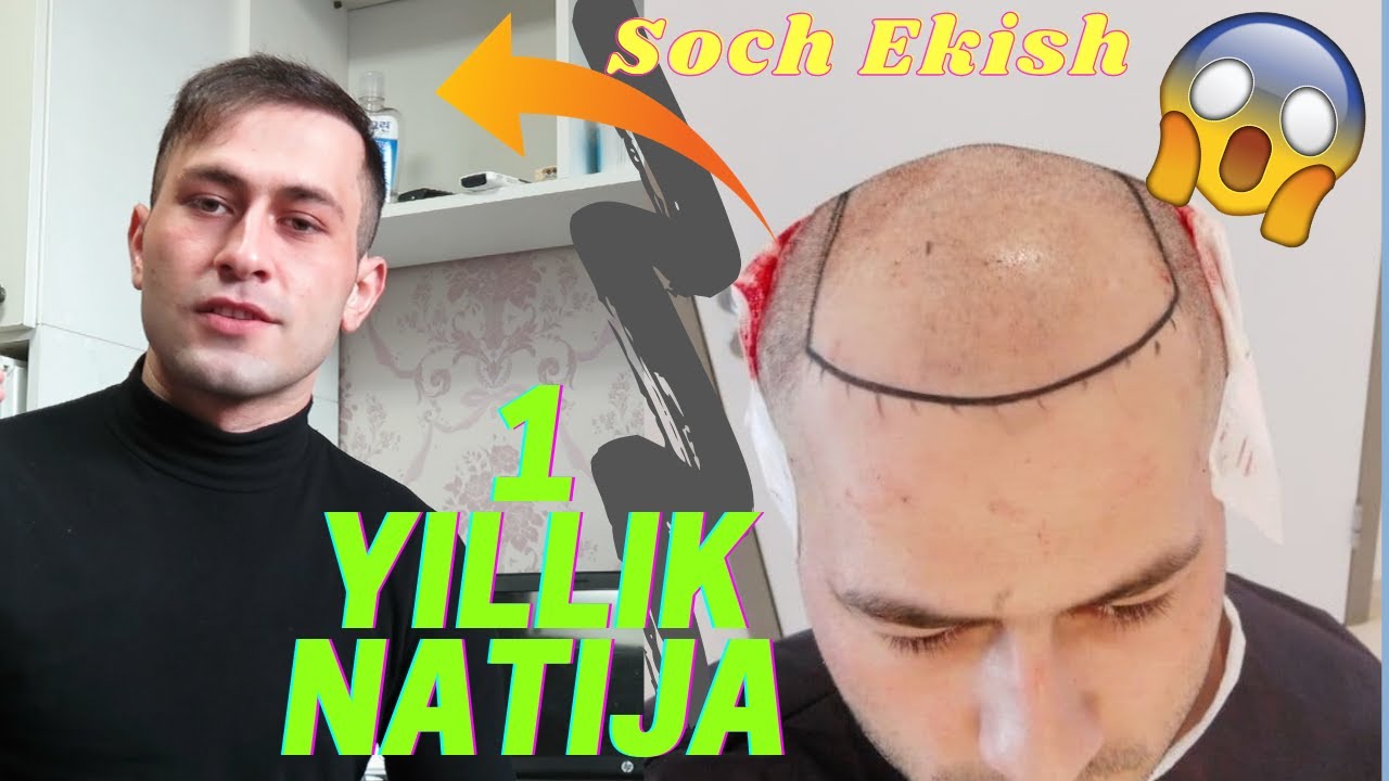 Soch ektirishning 1 yillik natijasi qanday bo'ldi?