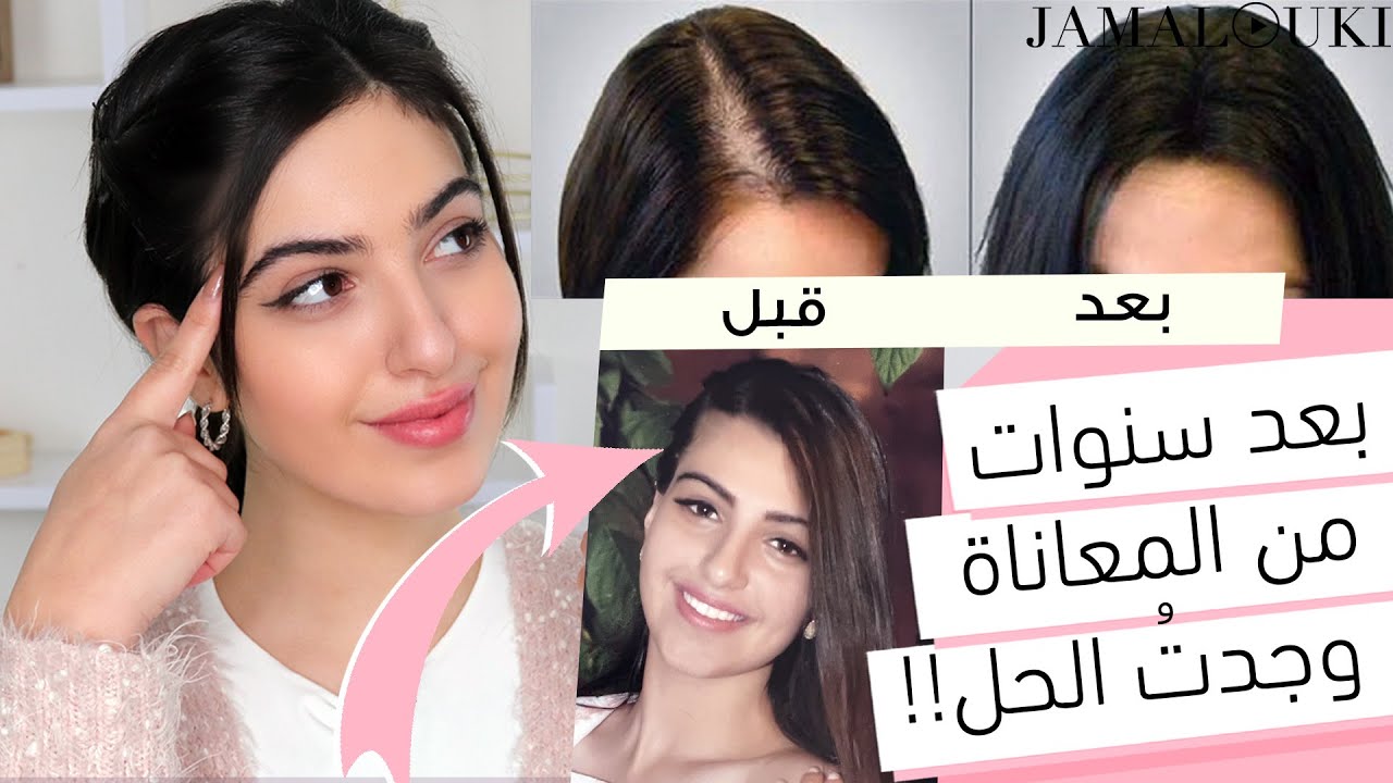علاج مشكلة تساقط الشعر وملئ الفراغات + إليكِ وصفة منزلية مضمونة | تطويل الشعر