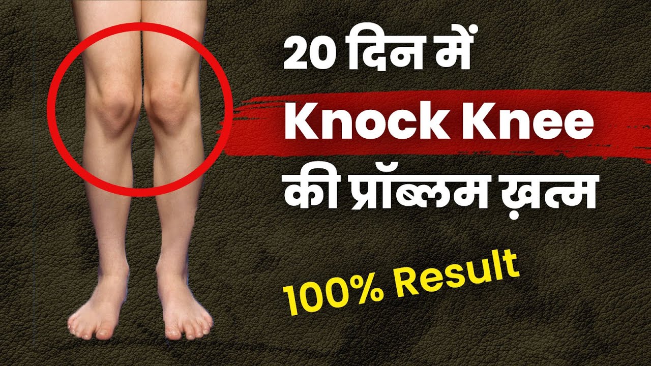 ghutna touch hote Hai kese dur kare। gutna judta Hai dur kare। knees exercise। knock knee correction